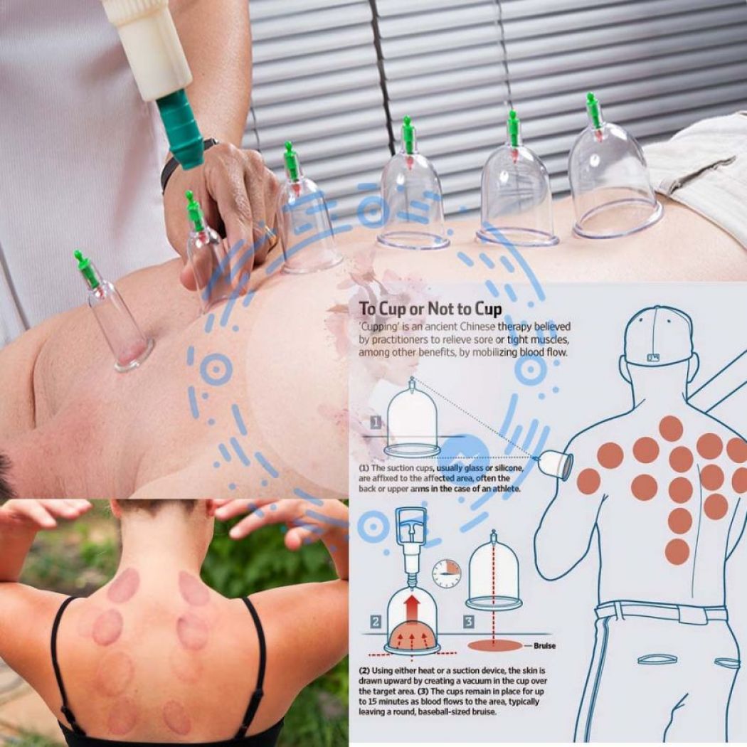 Cupping Therapy. Body Healthy Care 12 Plastic Cups Kit